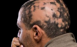 A person with Alopecia Areata, showing patchy hair loss on the scalp. The image illustrates the characteristic round bald patches typical of Alopecia Areata, a type of autoimmune-related Alopecia.