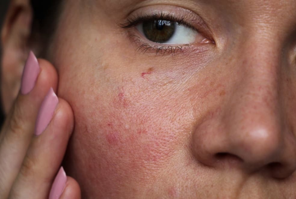 "Image showing a woman with red, irritated skin around her eyebrows after a brow waxing session, highlighting the importance of being aware of skin sensitivities and allergies before waxing."