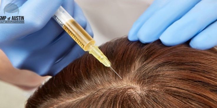 Person receiving Alopecia treatment for hair loss, undergoing therapy session with a dermatologist, focusing on scalp care