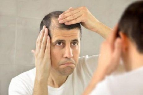 Person with Alopecia demonstrating hair loss on scalp, emphasizing the impact and management of Alopecia in individuals.