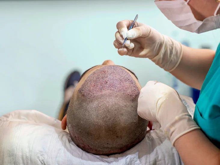 **Image Alternative Text:** 
A depiction of surgical treatments for alopecia, showcasing hair transplantation and scalp reduction procedures aimed at addressing hair loss caused by alopecia.